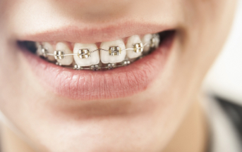 Closeup of smile with classic braces